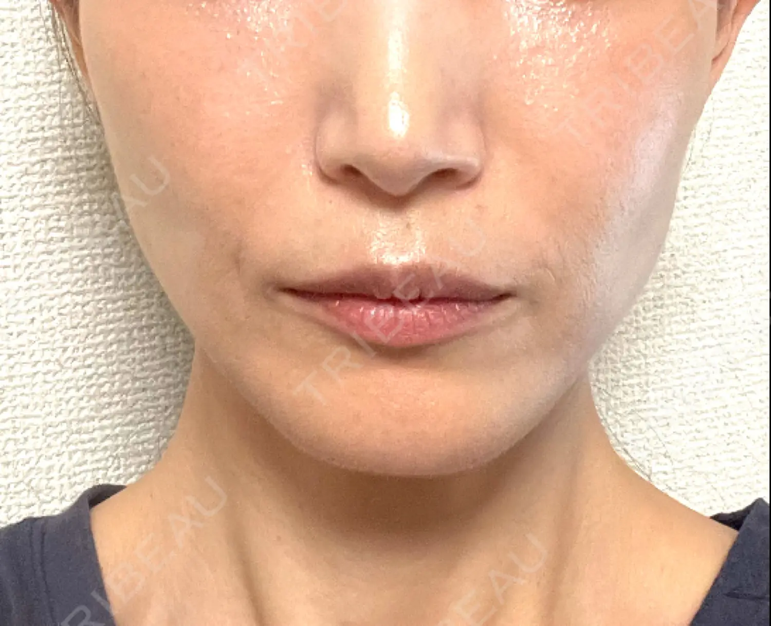 施術後の写真