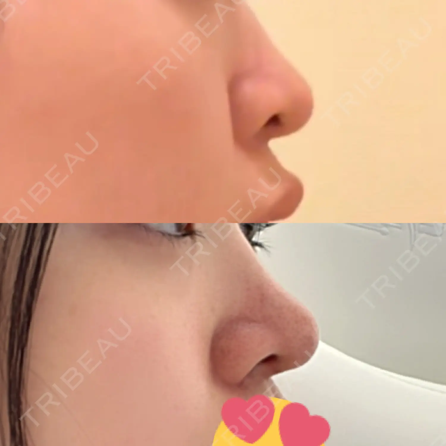 施術後の写真