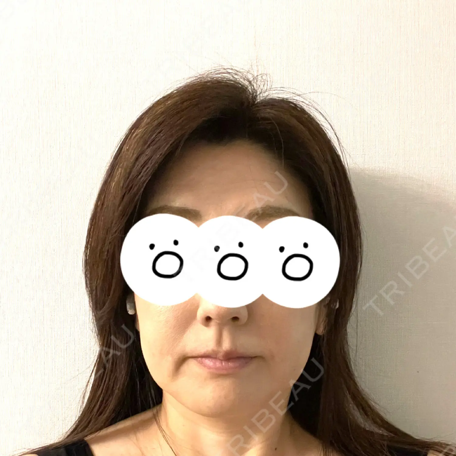 施術後の写真