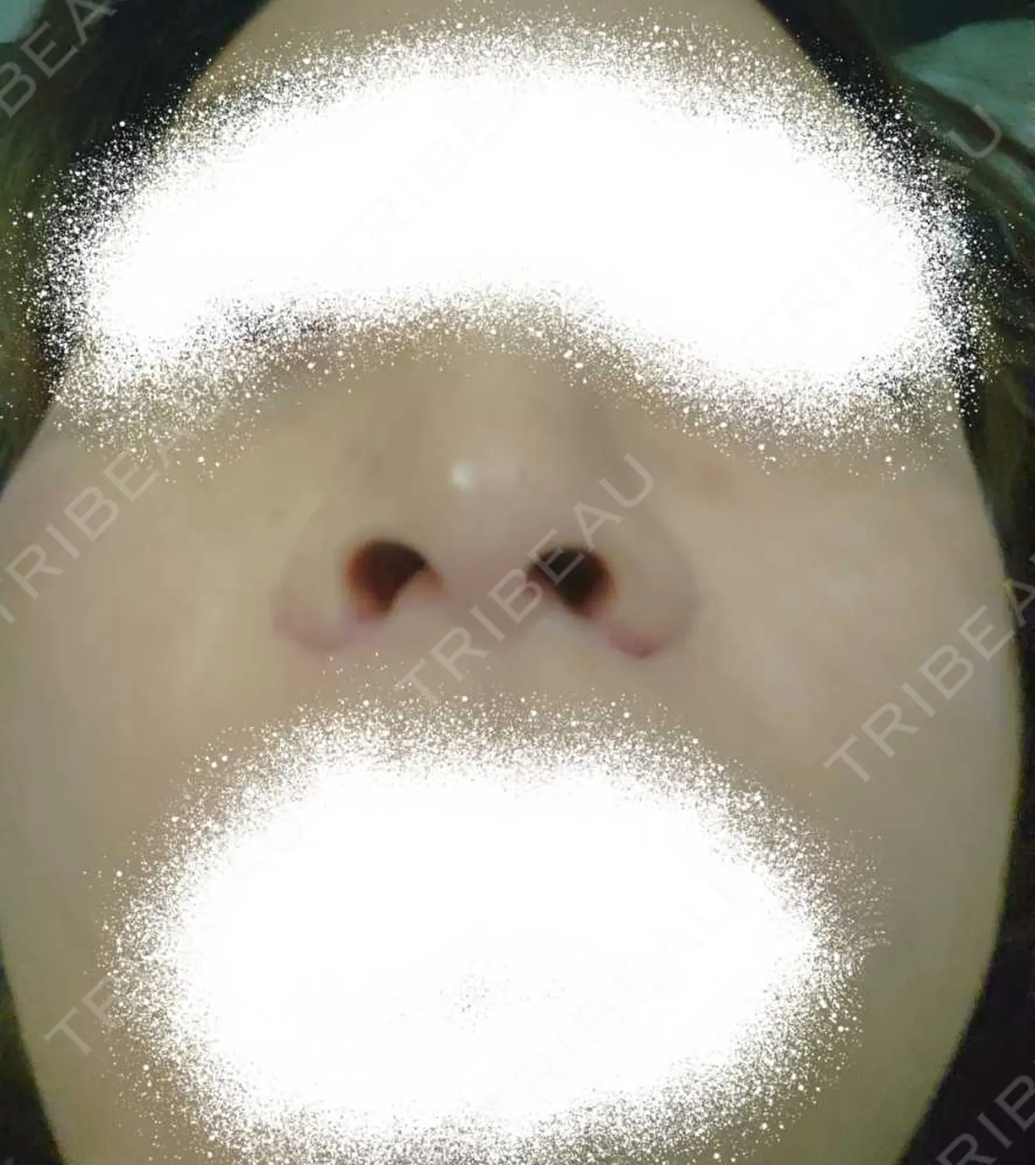 施術後の写真