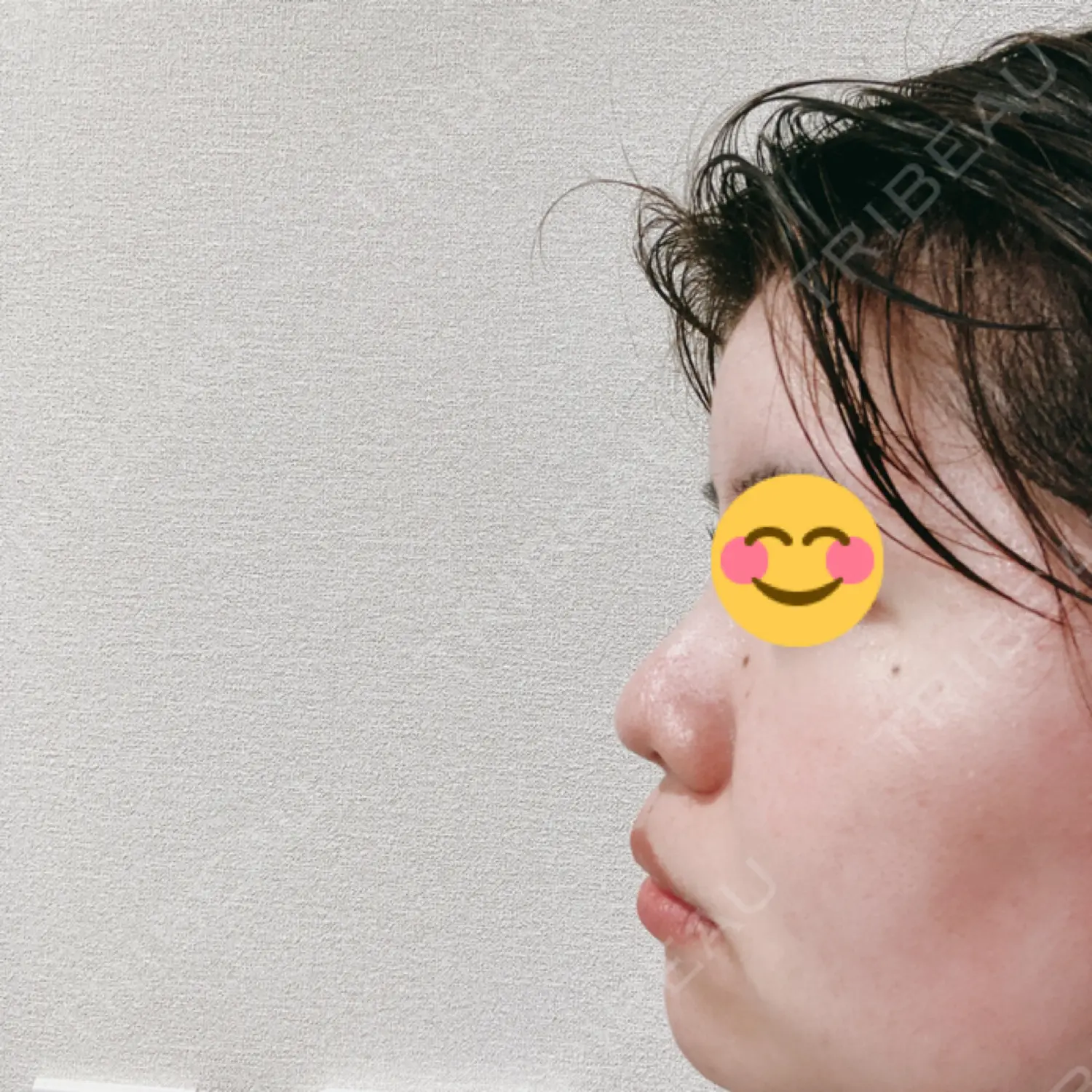 施術後の写真