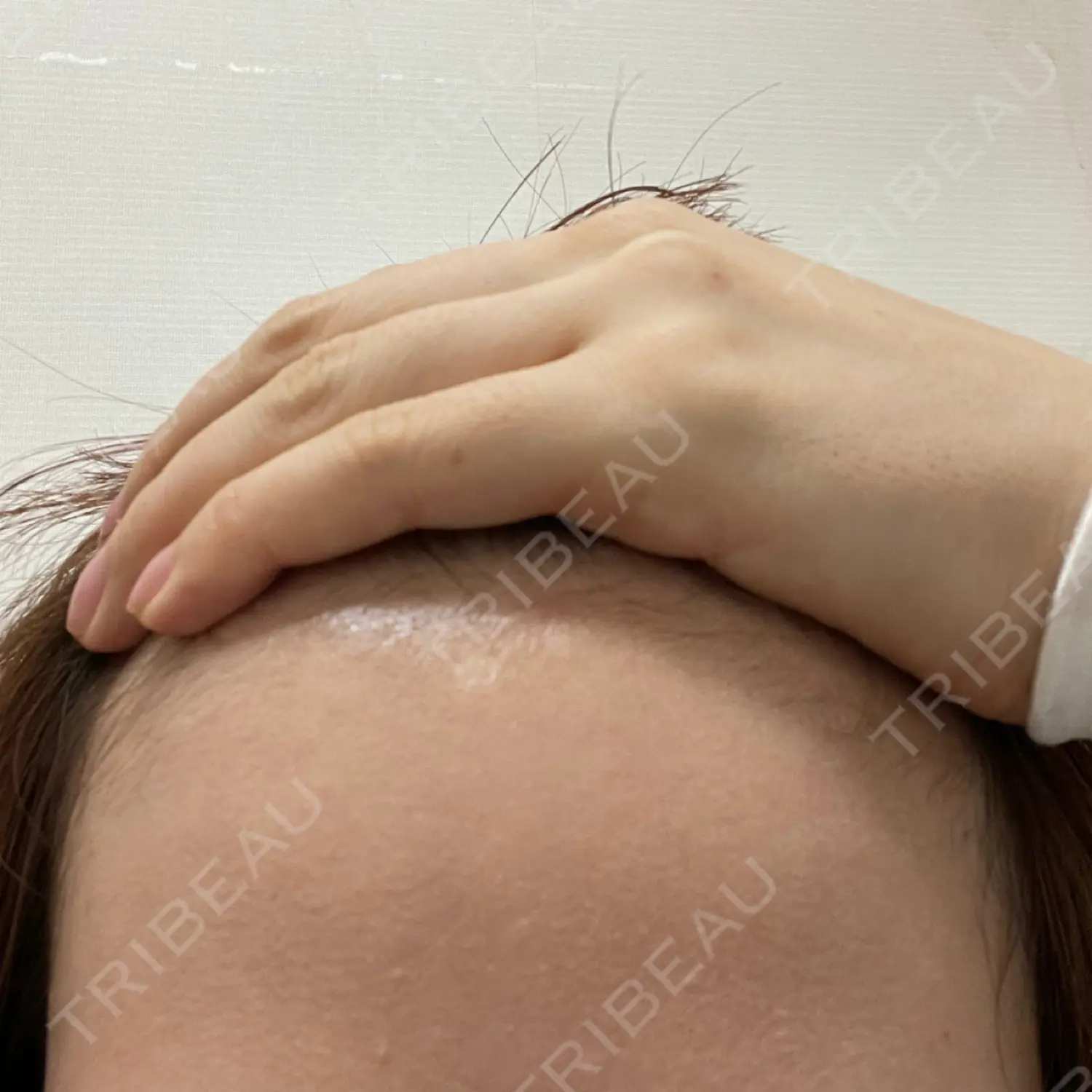 施術後の写真
