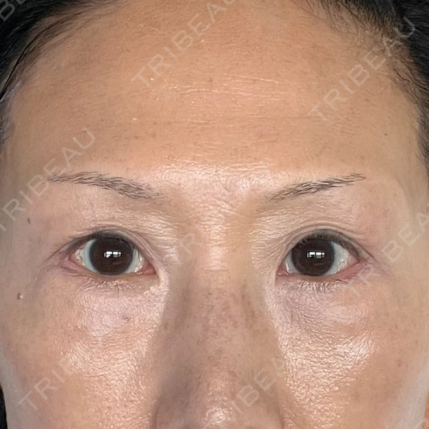 施術後の写真