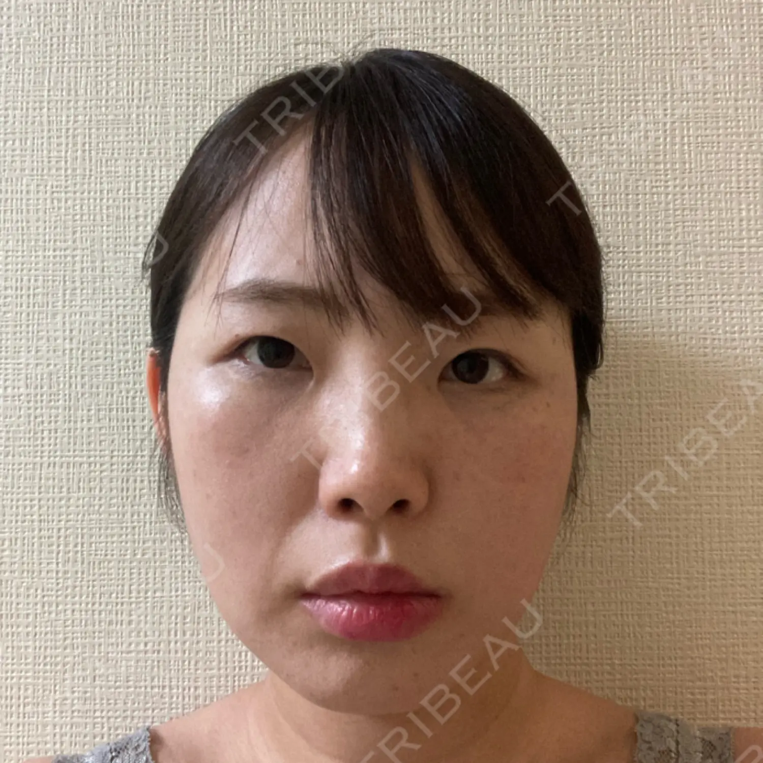 施術後の写真