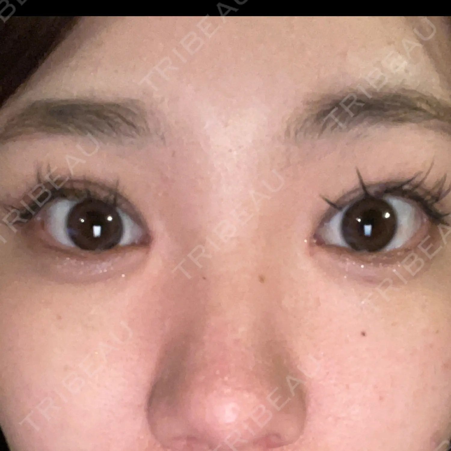 施術後の写真