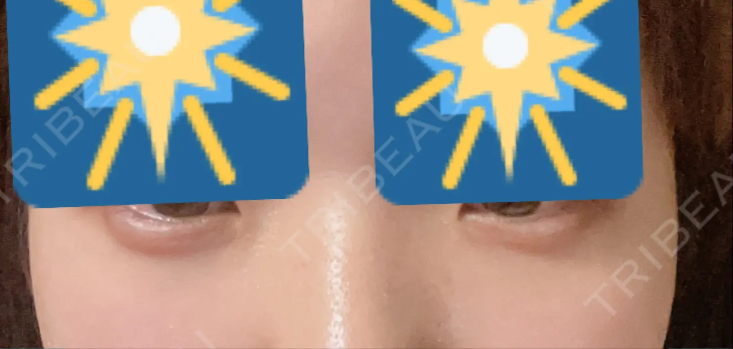 施術後の写真