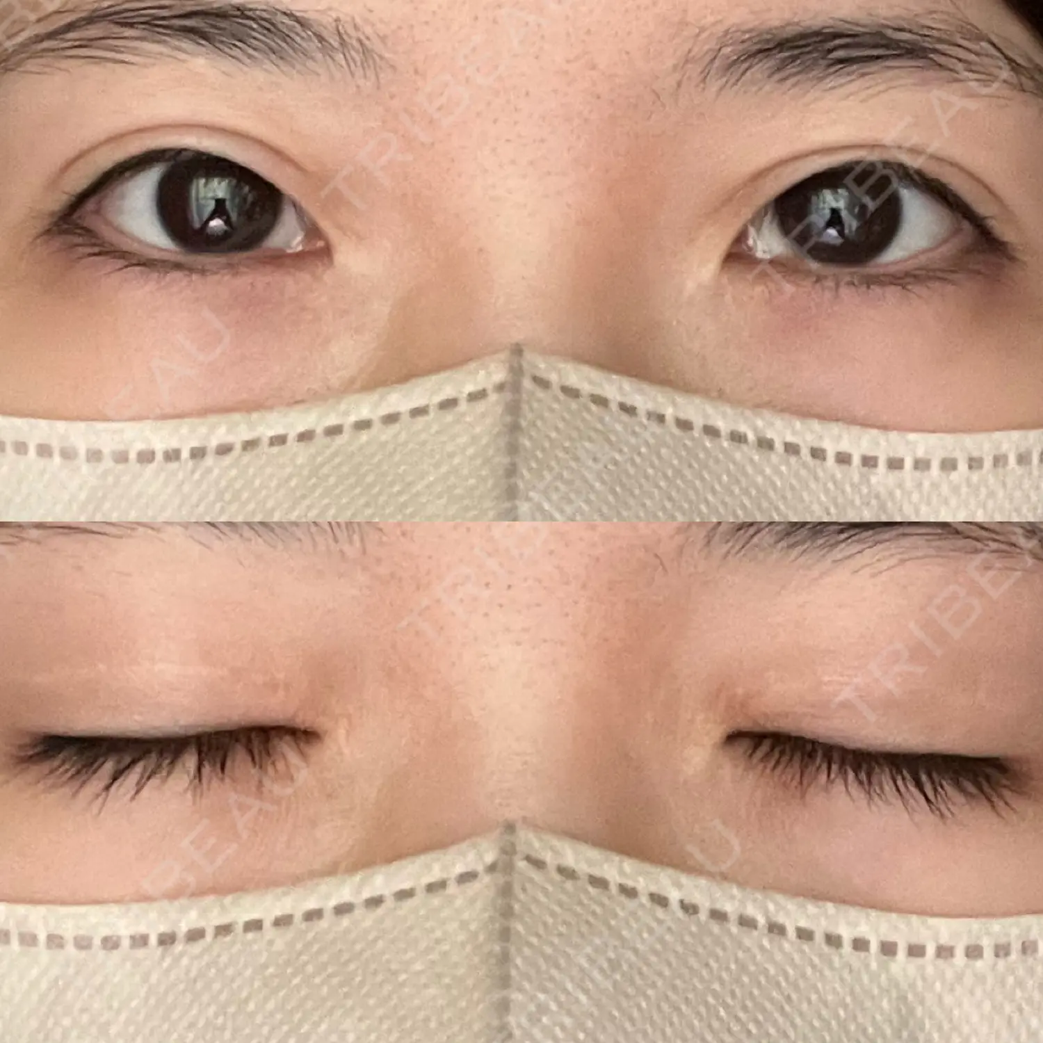 施術後の写真