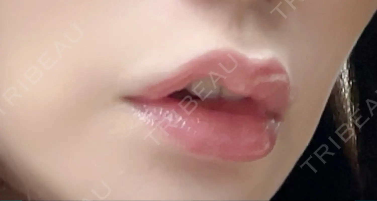 施術後の写真
