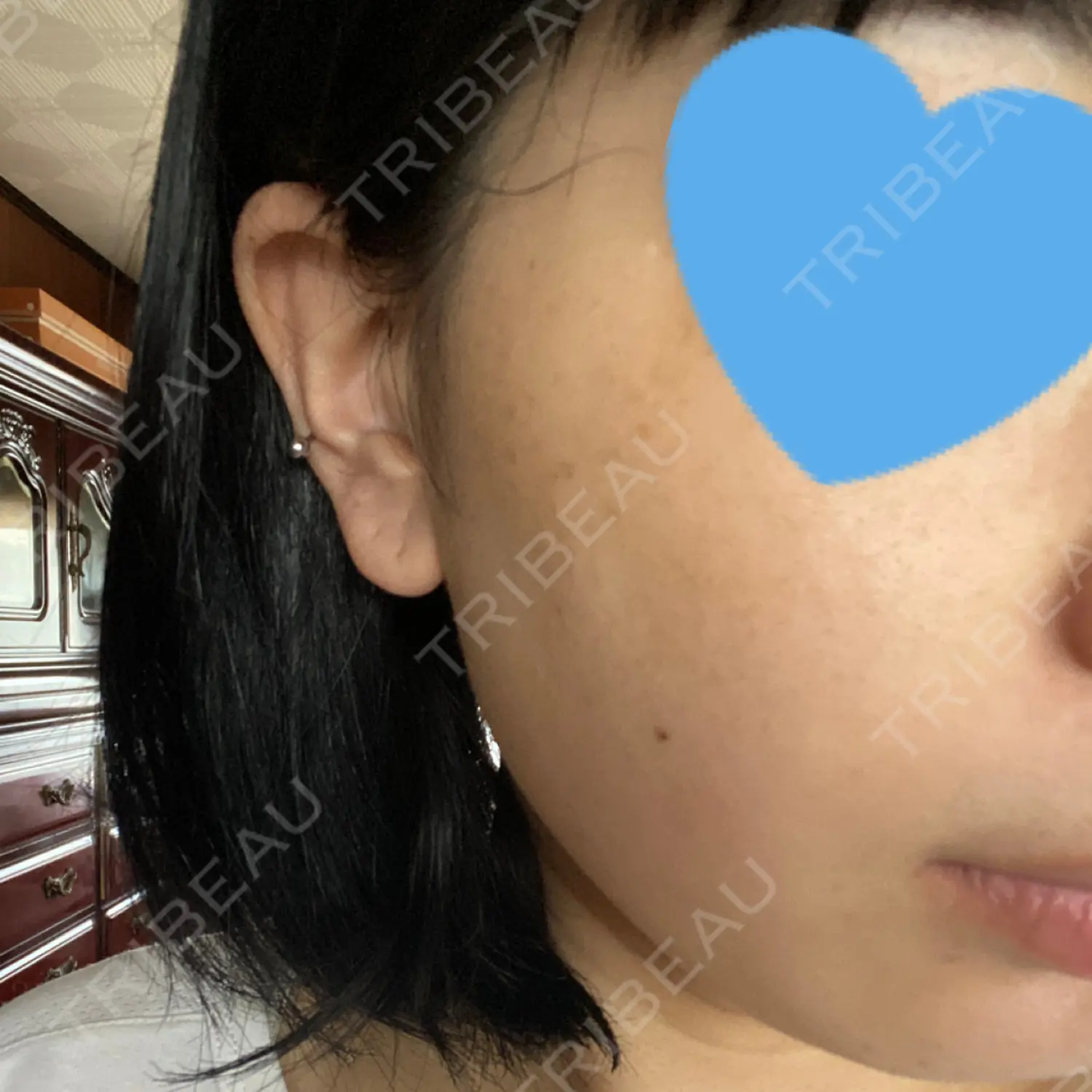 施術後の写真
