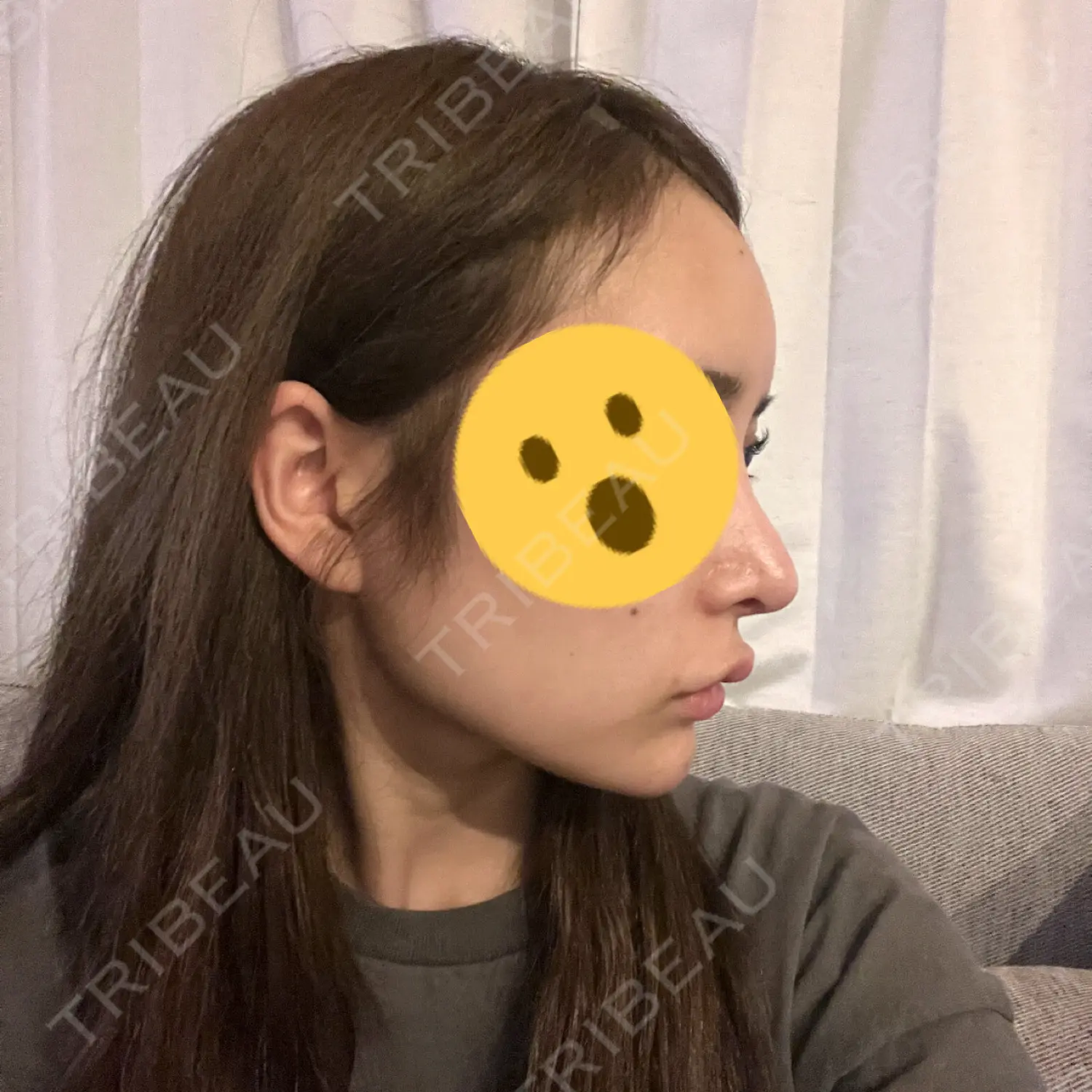 施術後の写真