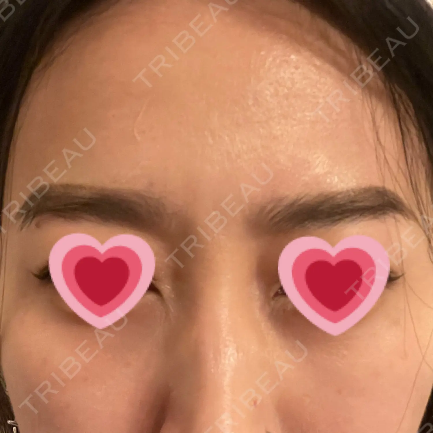 施術後の写真
