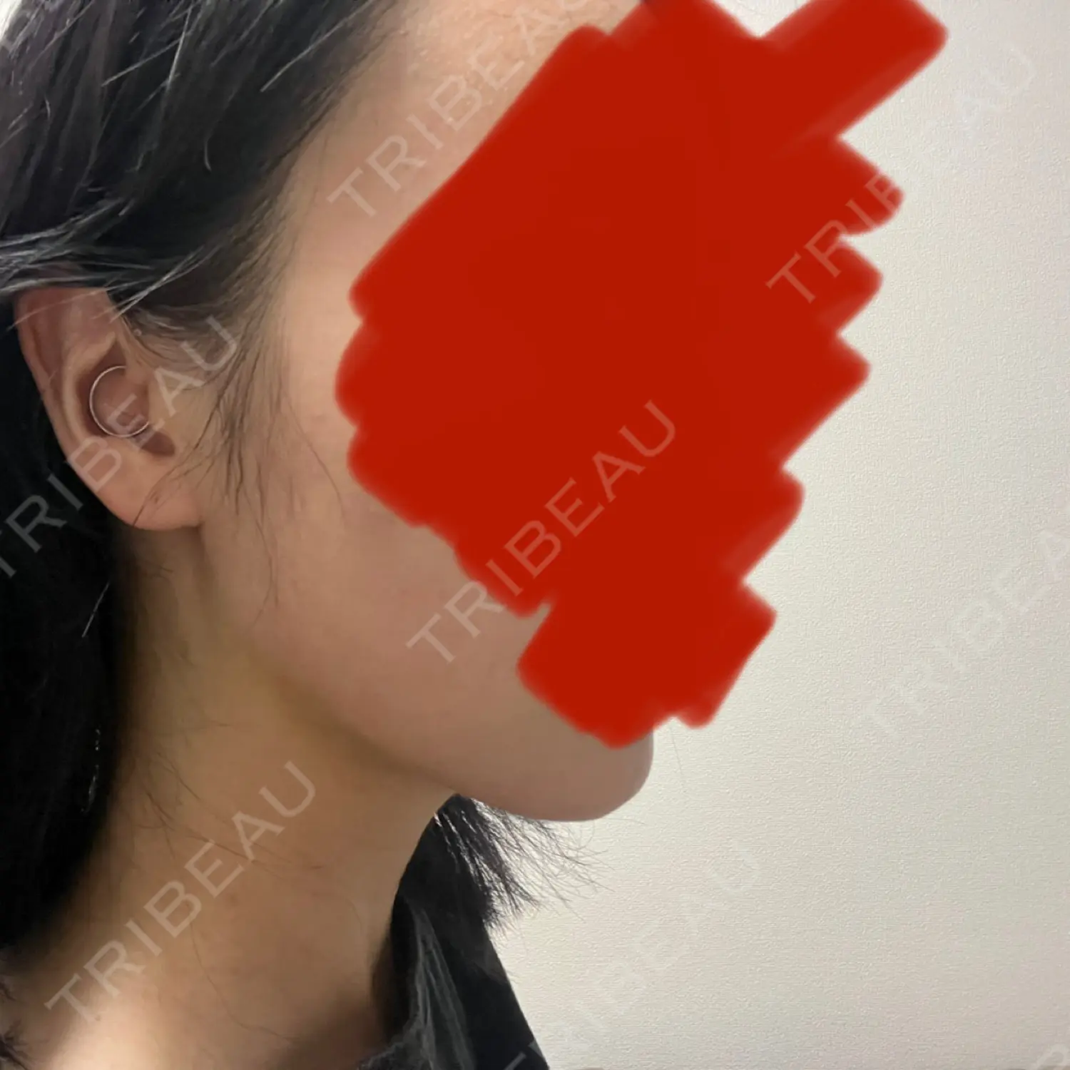 施術後の写真
