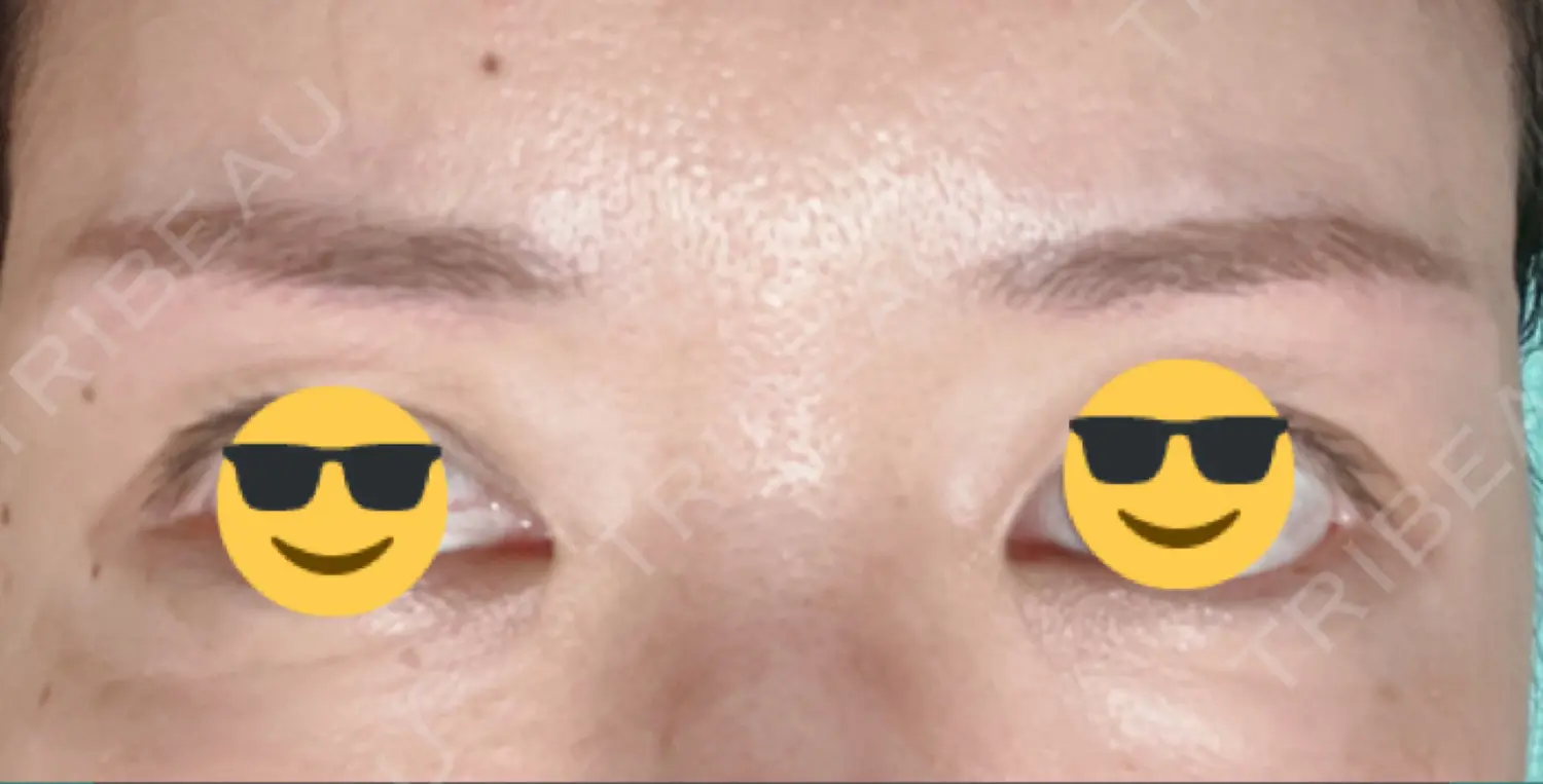 施術後の写真