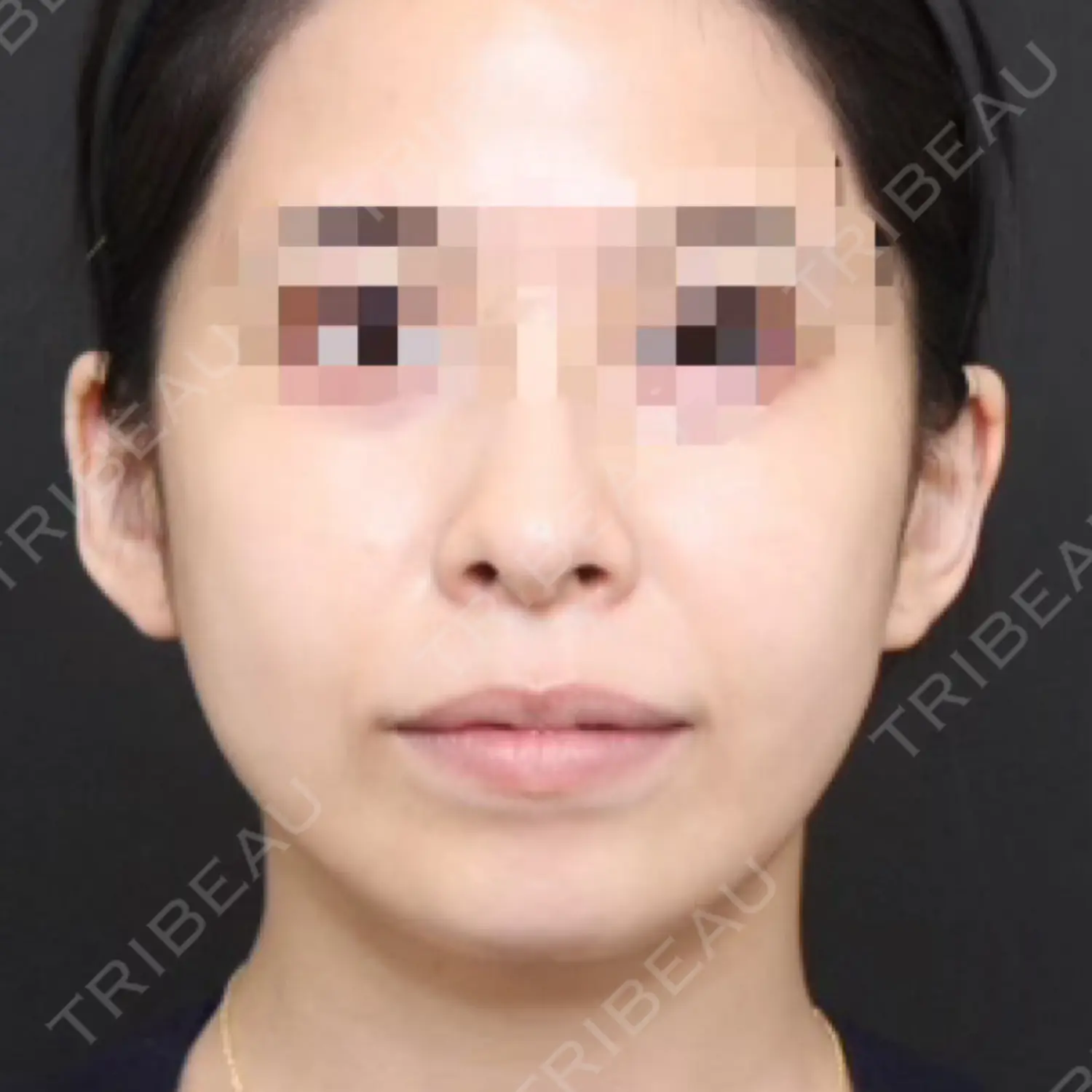 施術後の写真