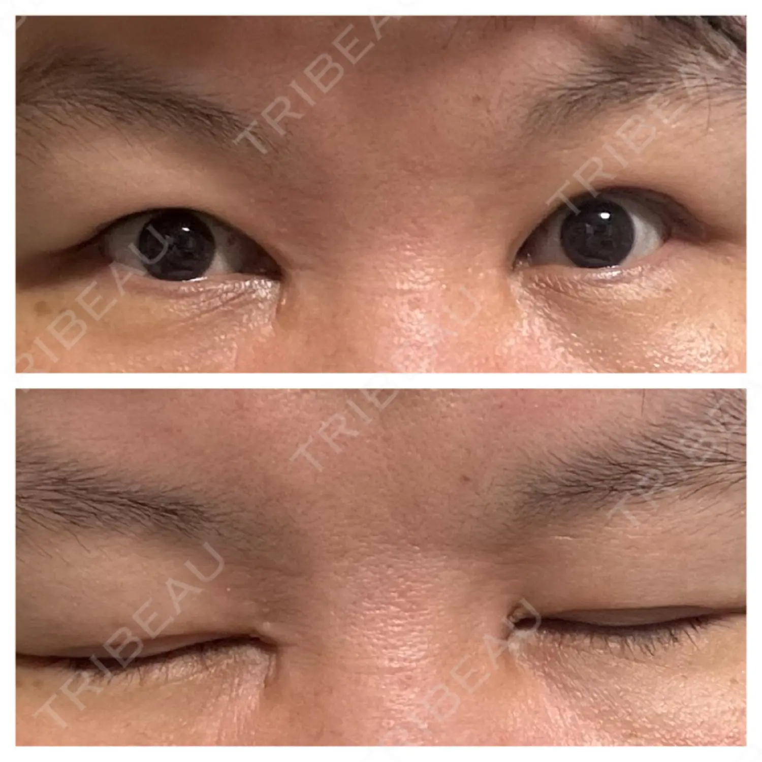施術後の写真