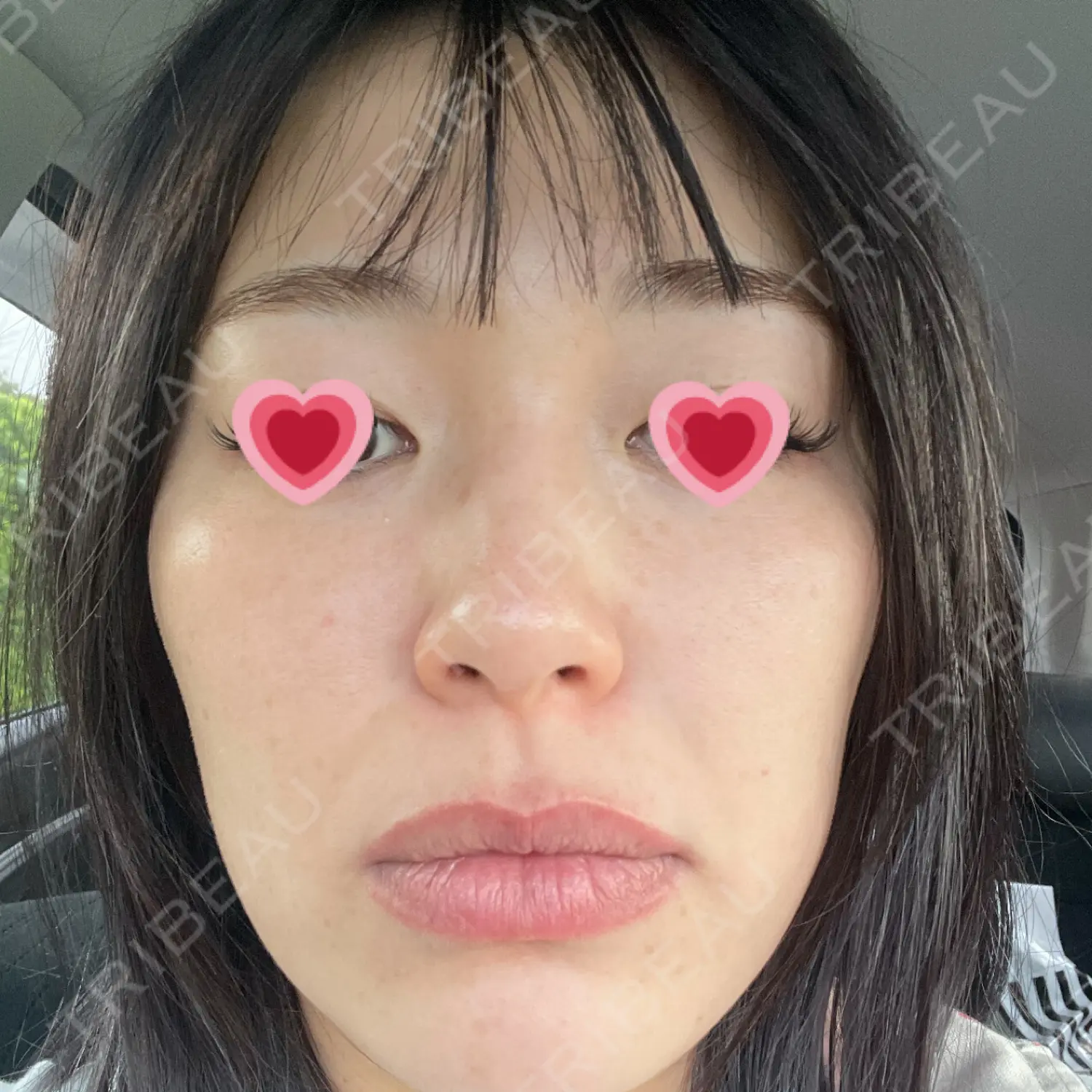 施術後の写真