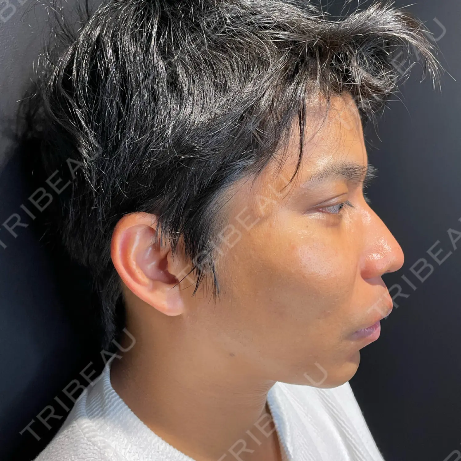 施術後の写真