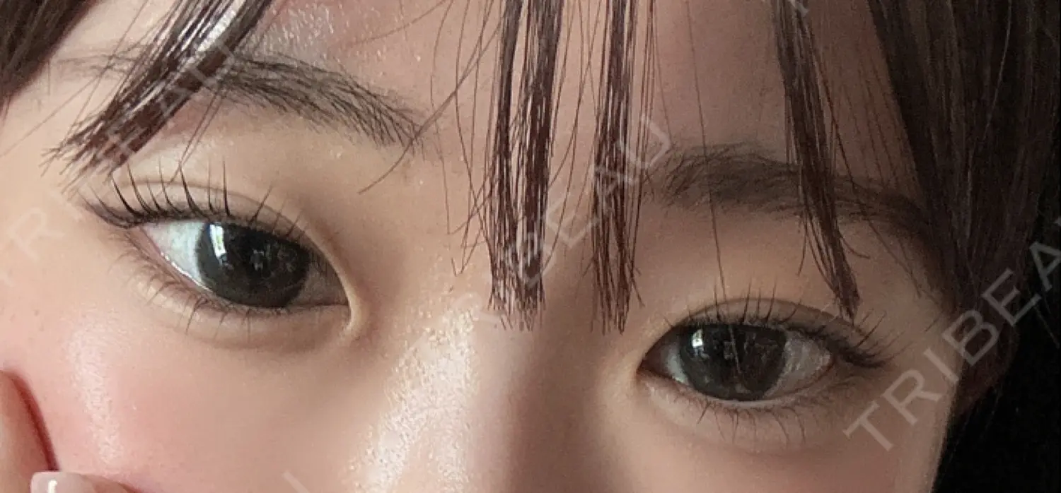 施術後の写真