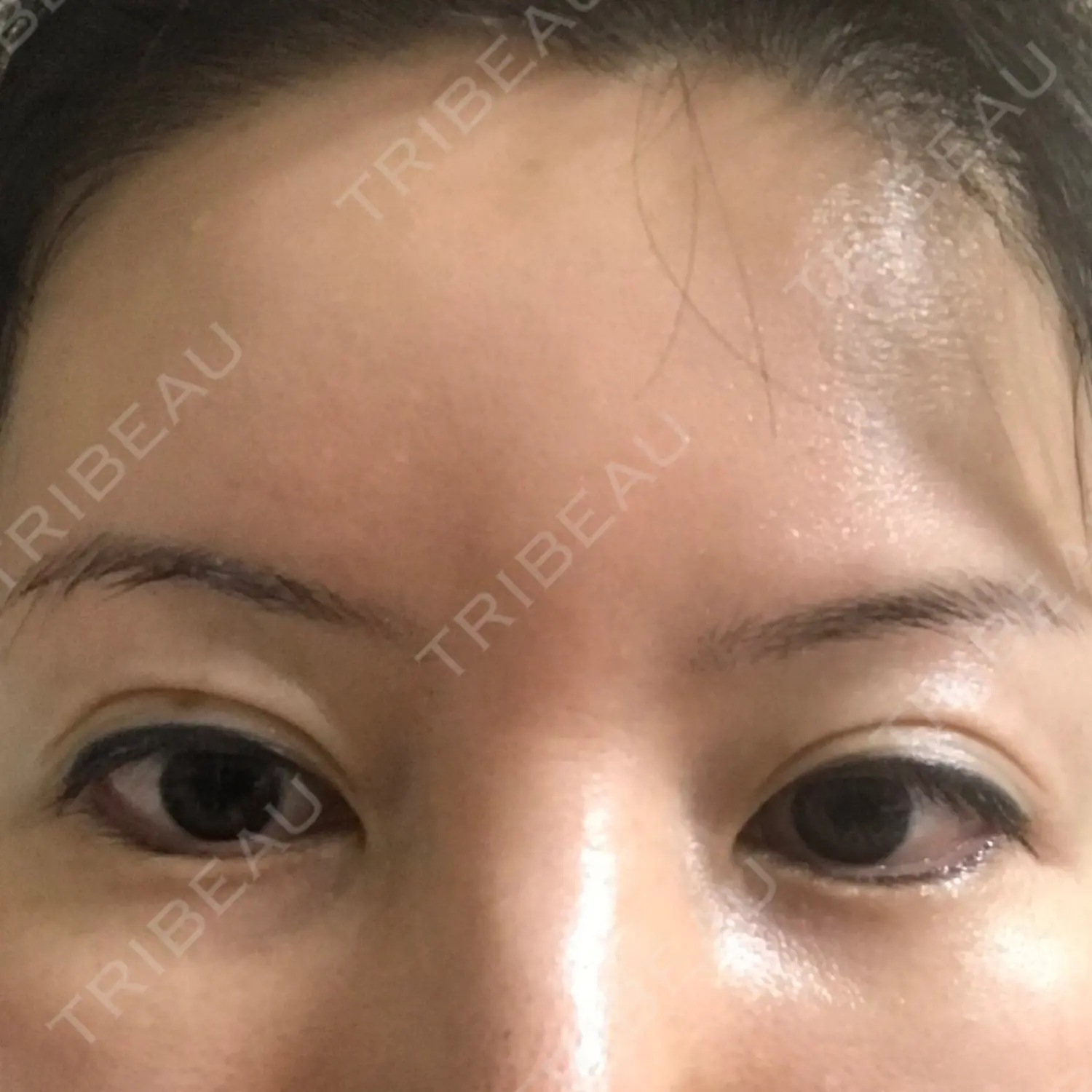 施術前の写真