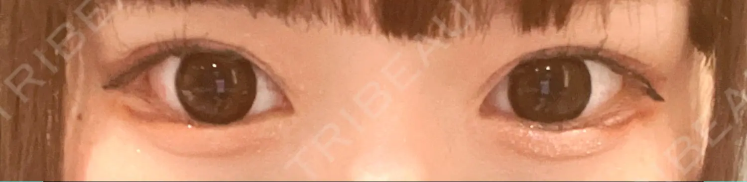 施術前の写真