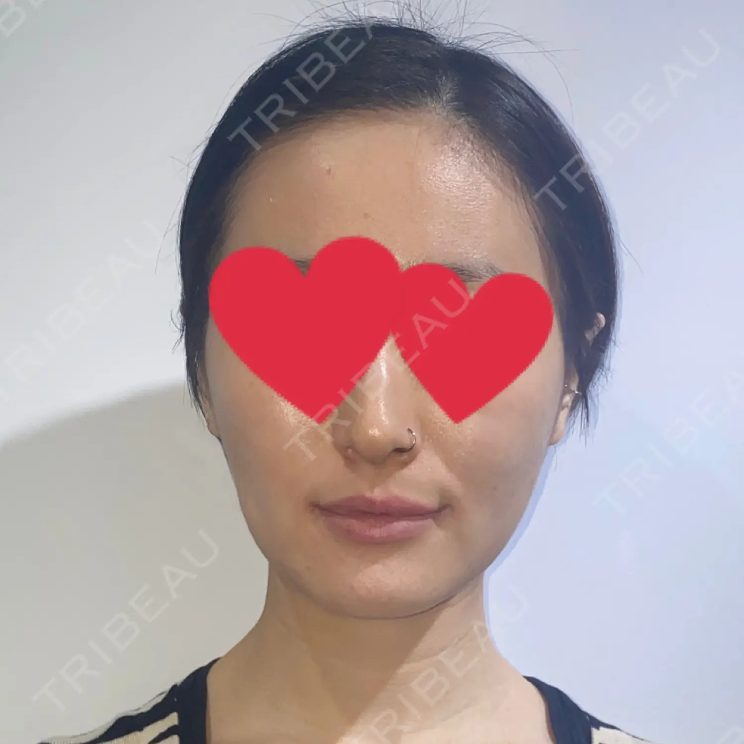 施術前の写真