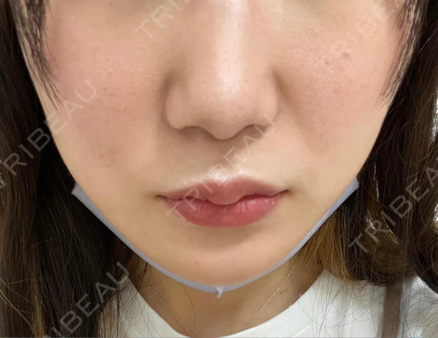 施術前の写真
