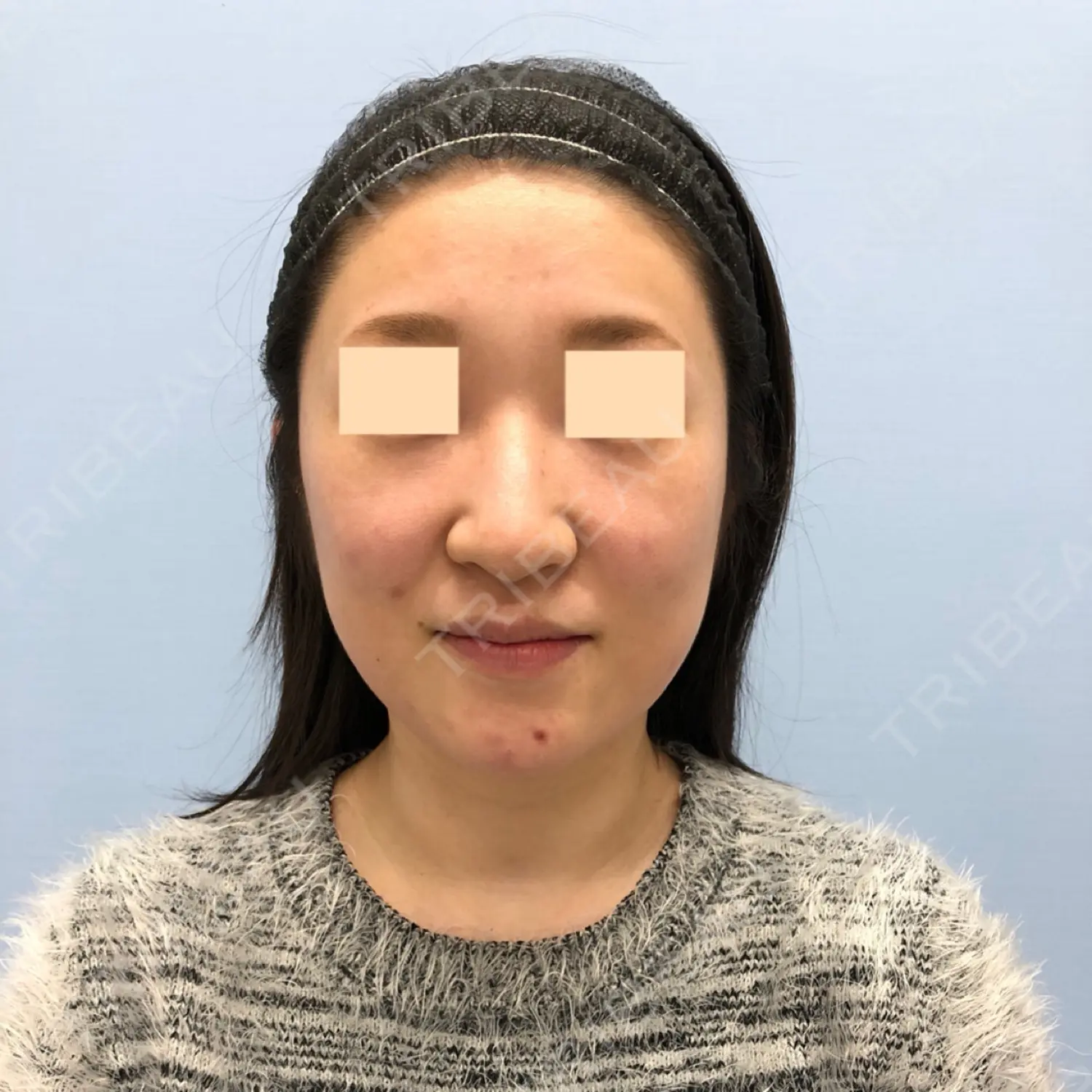 施術前の写真