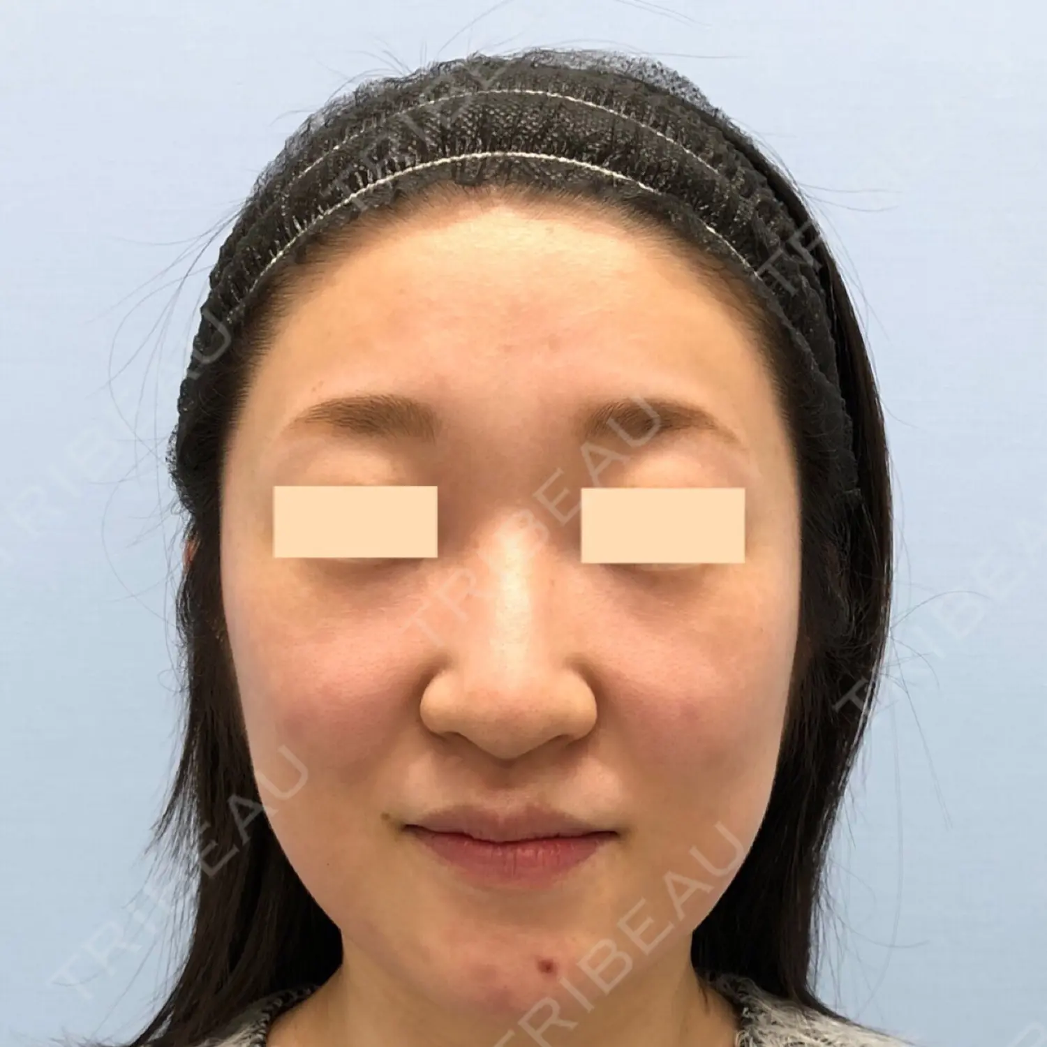 施術前の写真