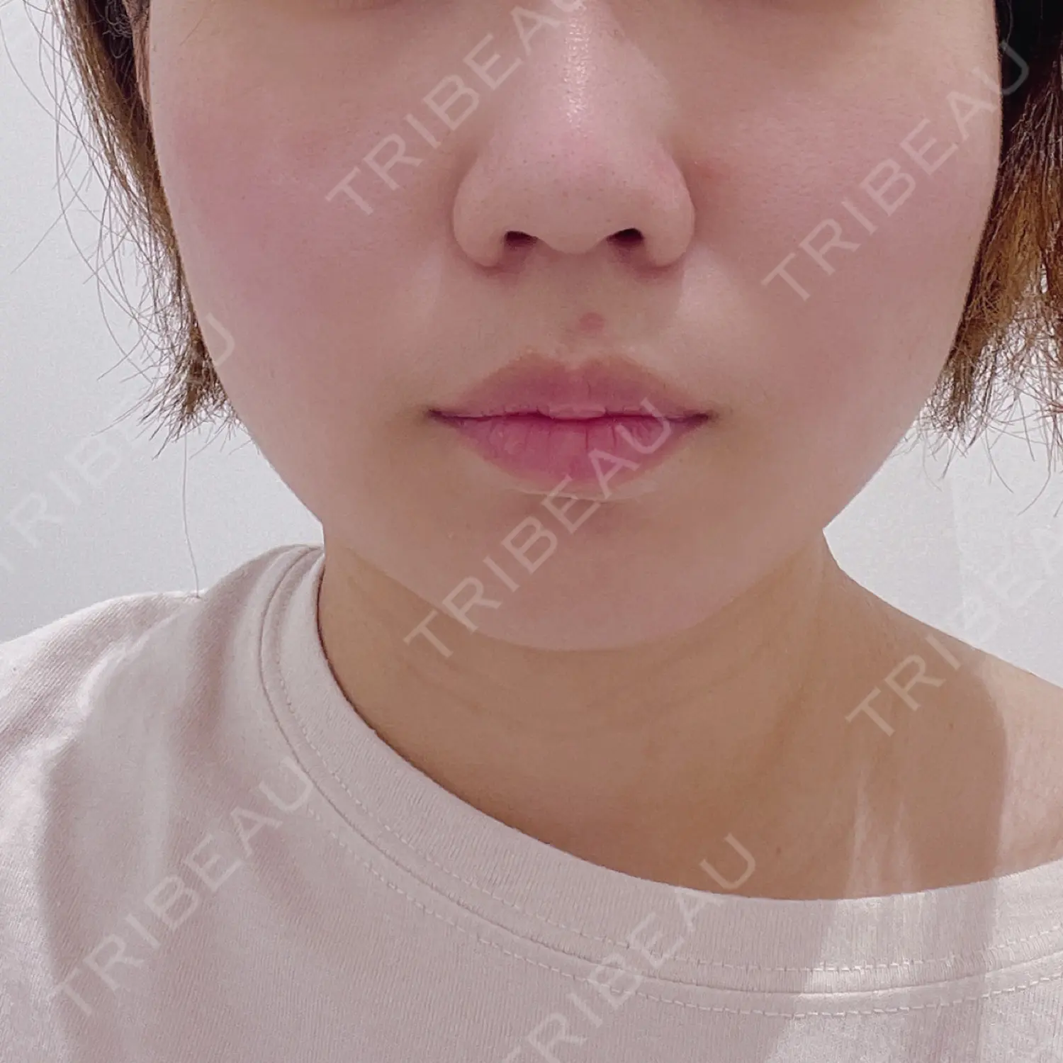 施術前の写真