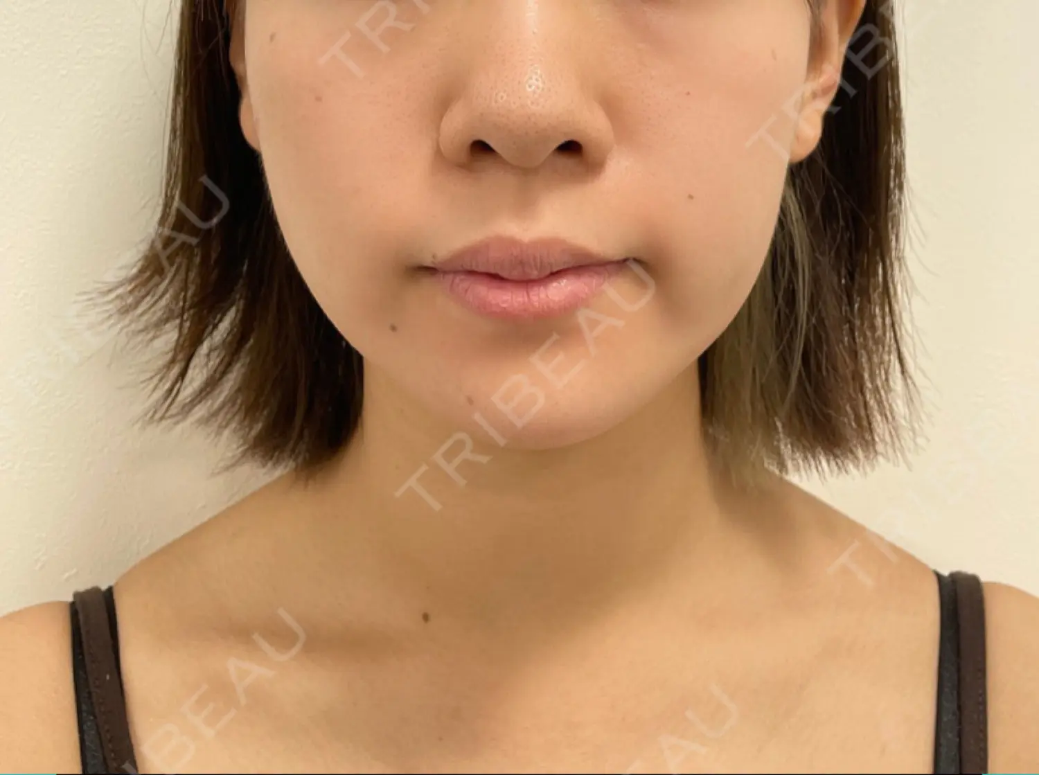 施術前の写真