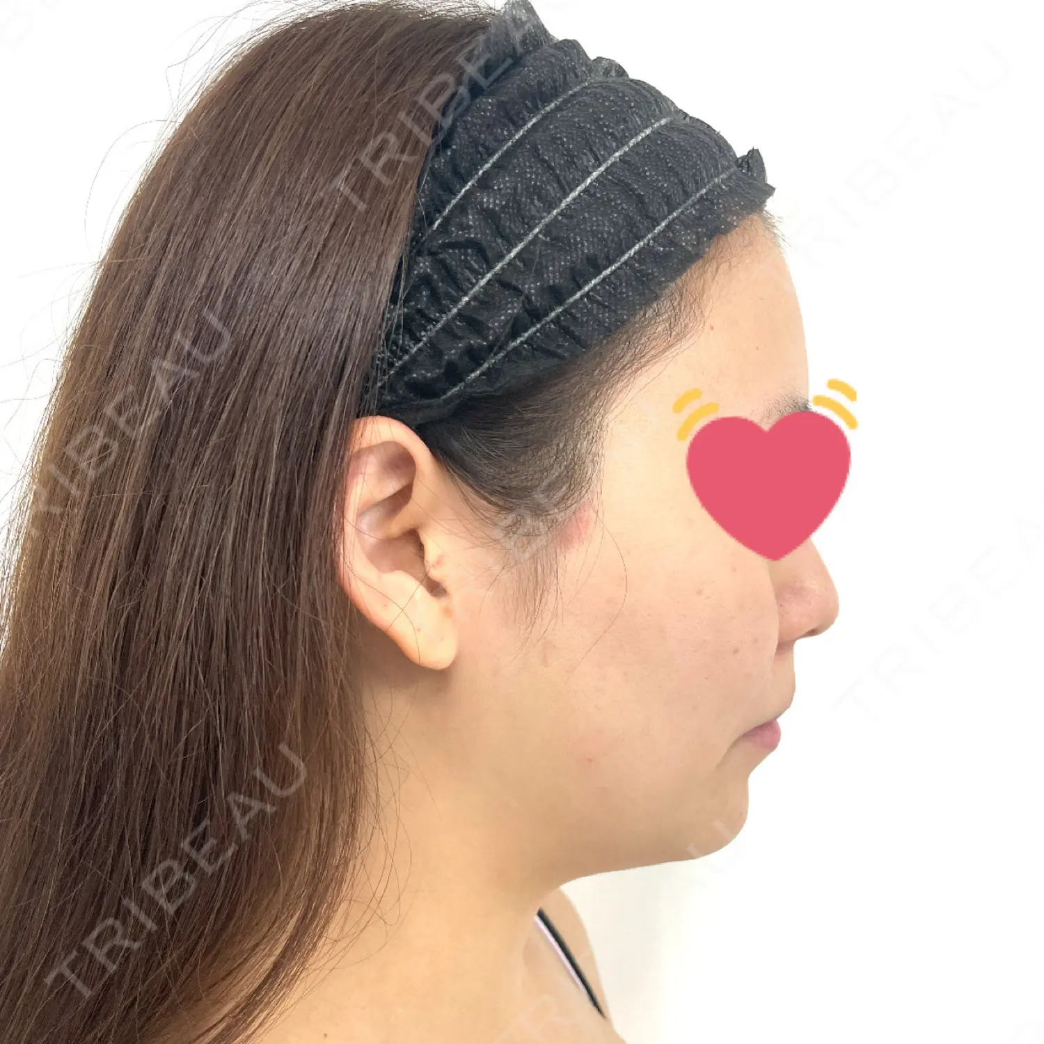 施術前の写真