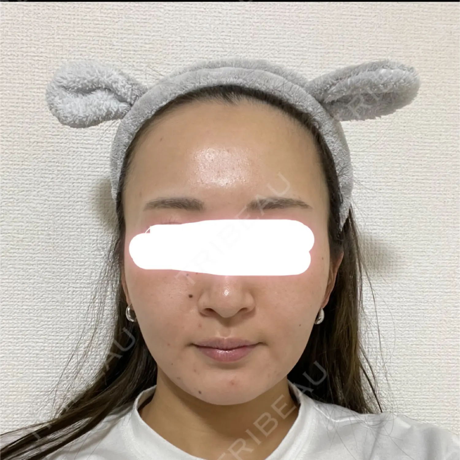 施術前の写真