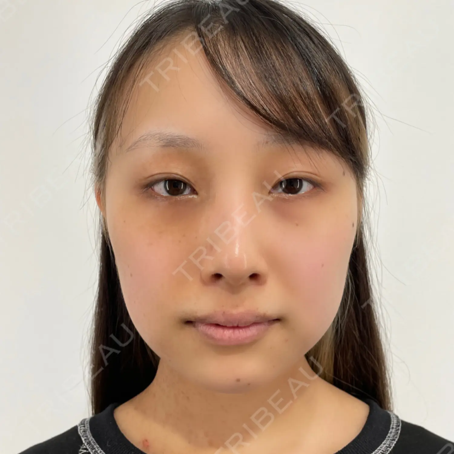 施術前の写真