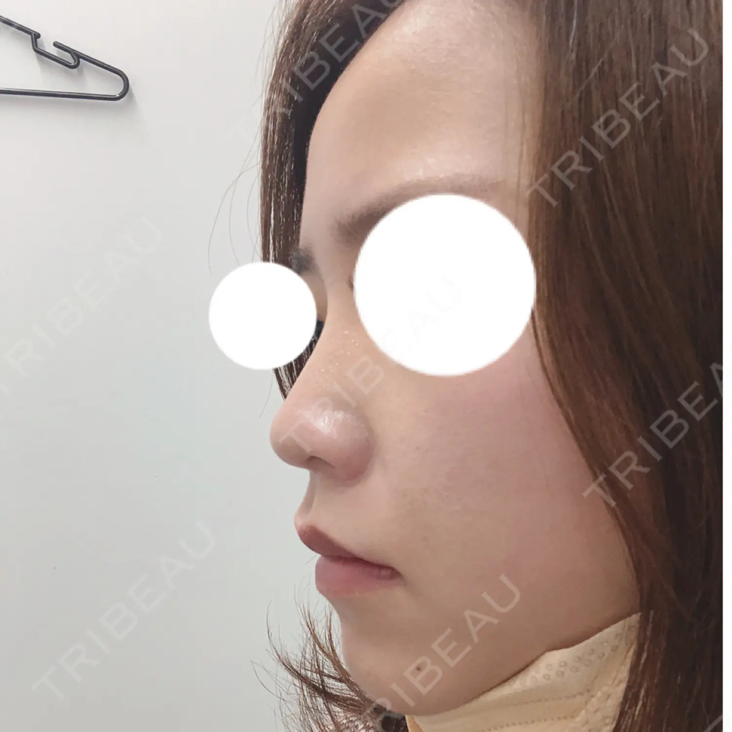 施術前の写真