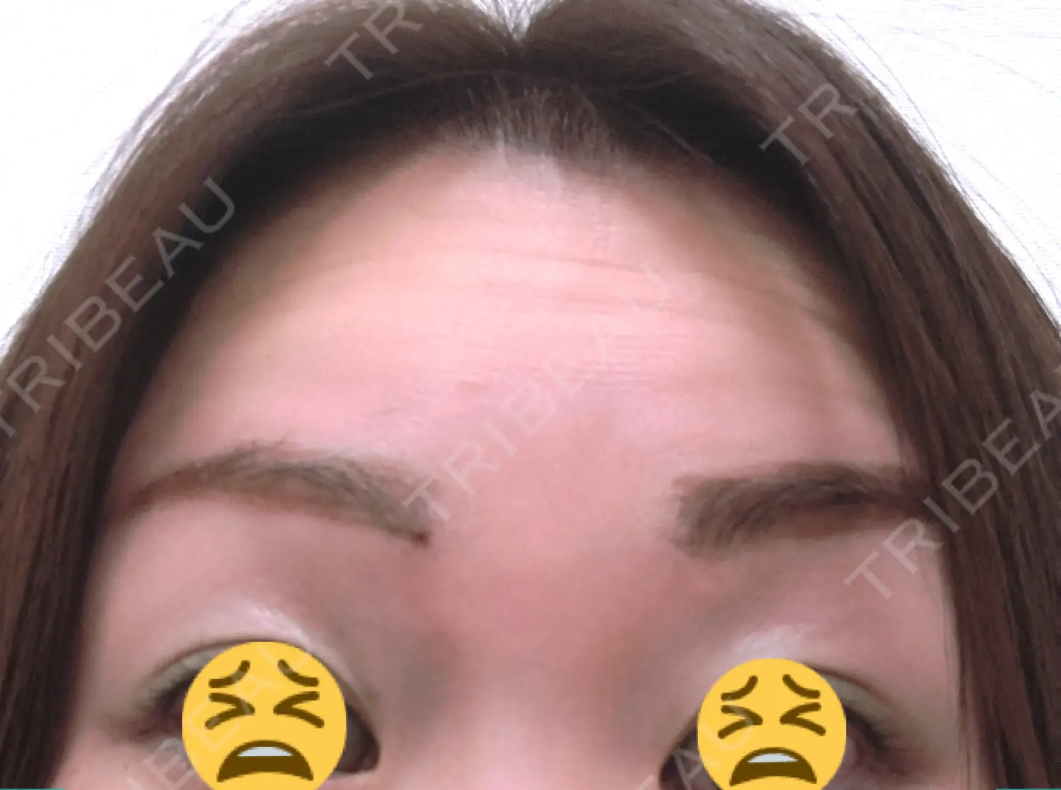 施術前の写真