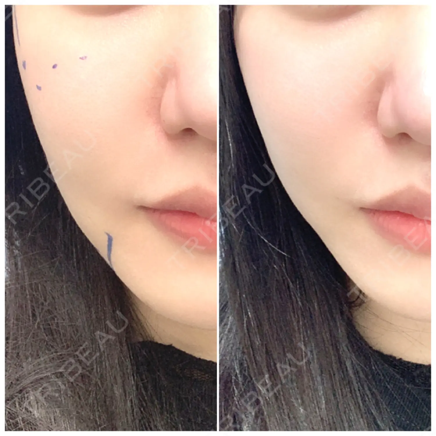 施術前の写真