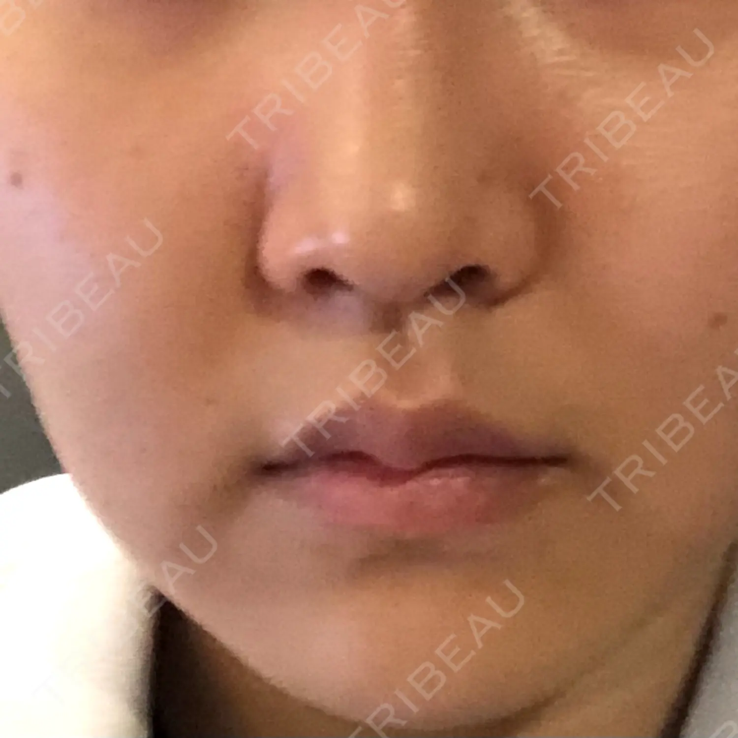 施術前の写真