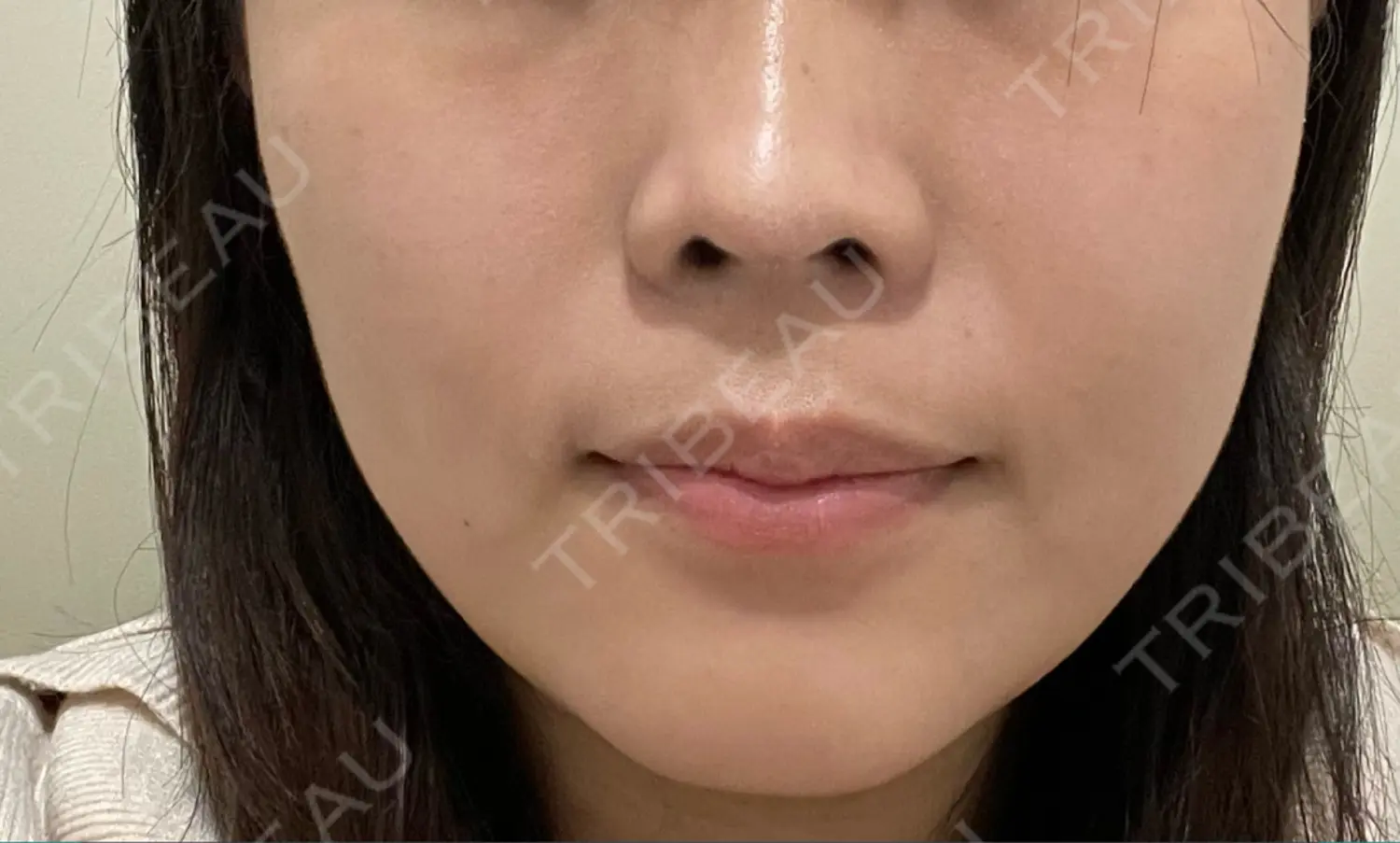 施術前の写真