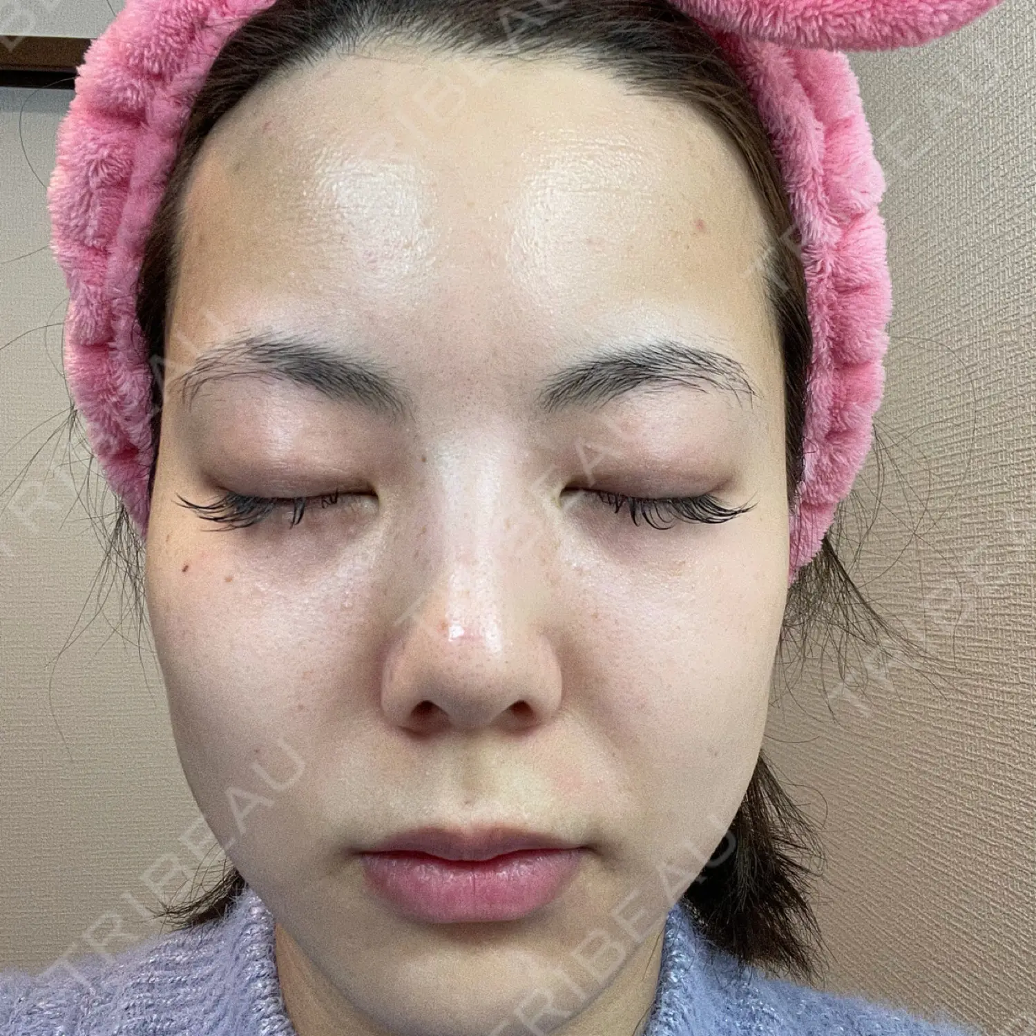 施術前の写真