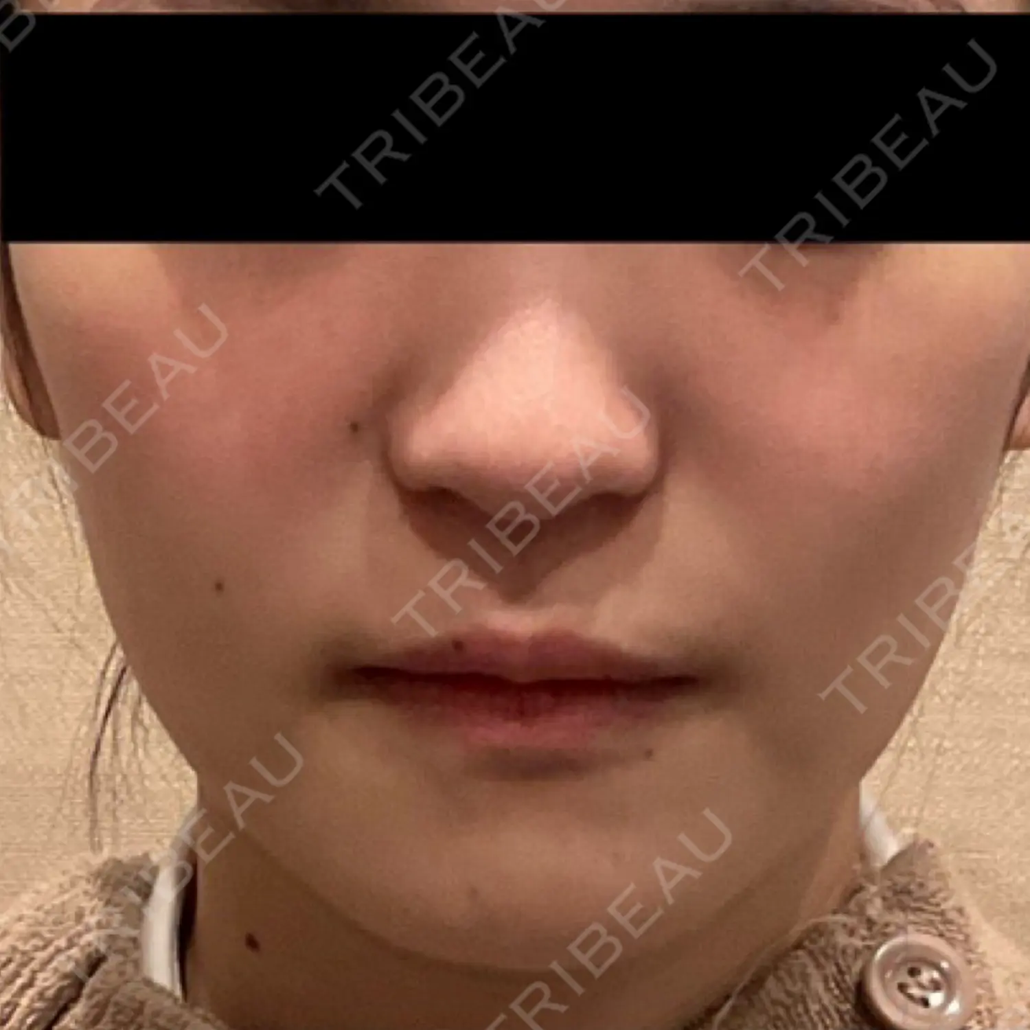 施術前の写真