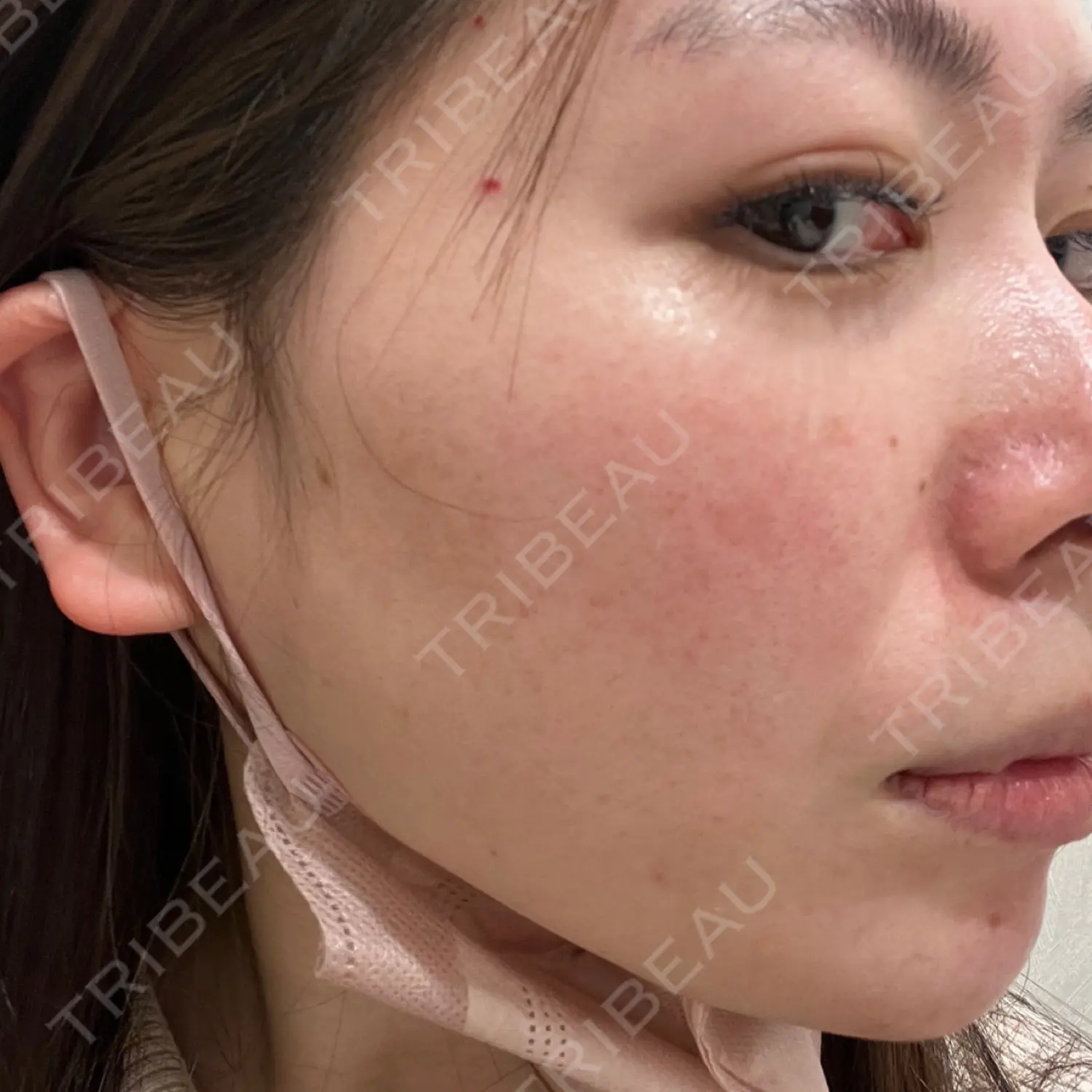 施術前の写真