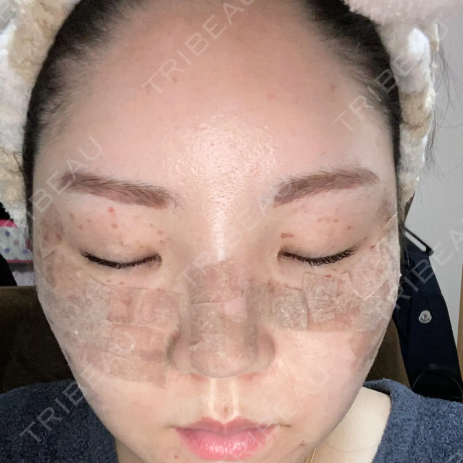 施術前の写真