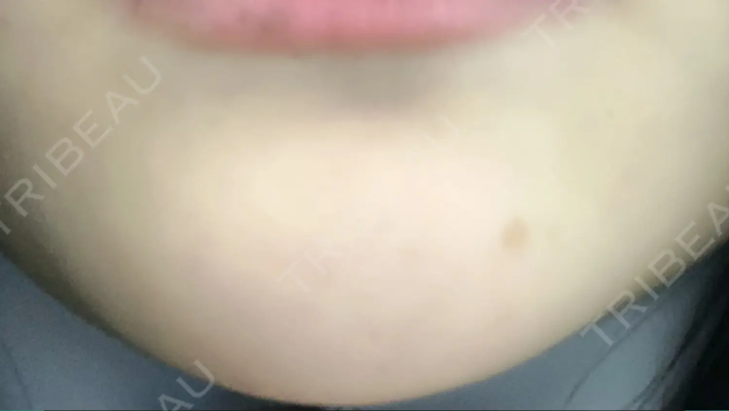 施術前の写真