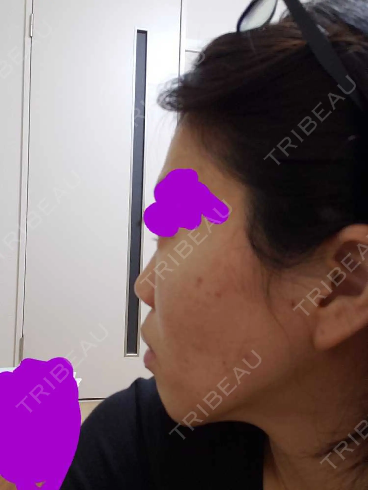 施術前の写真