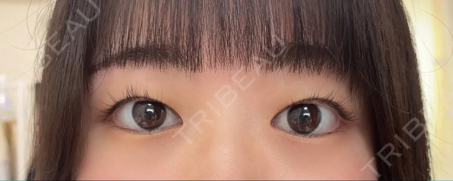 施術前の写真