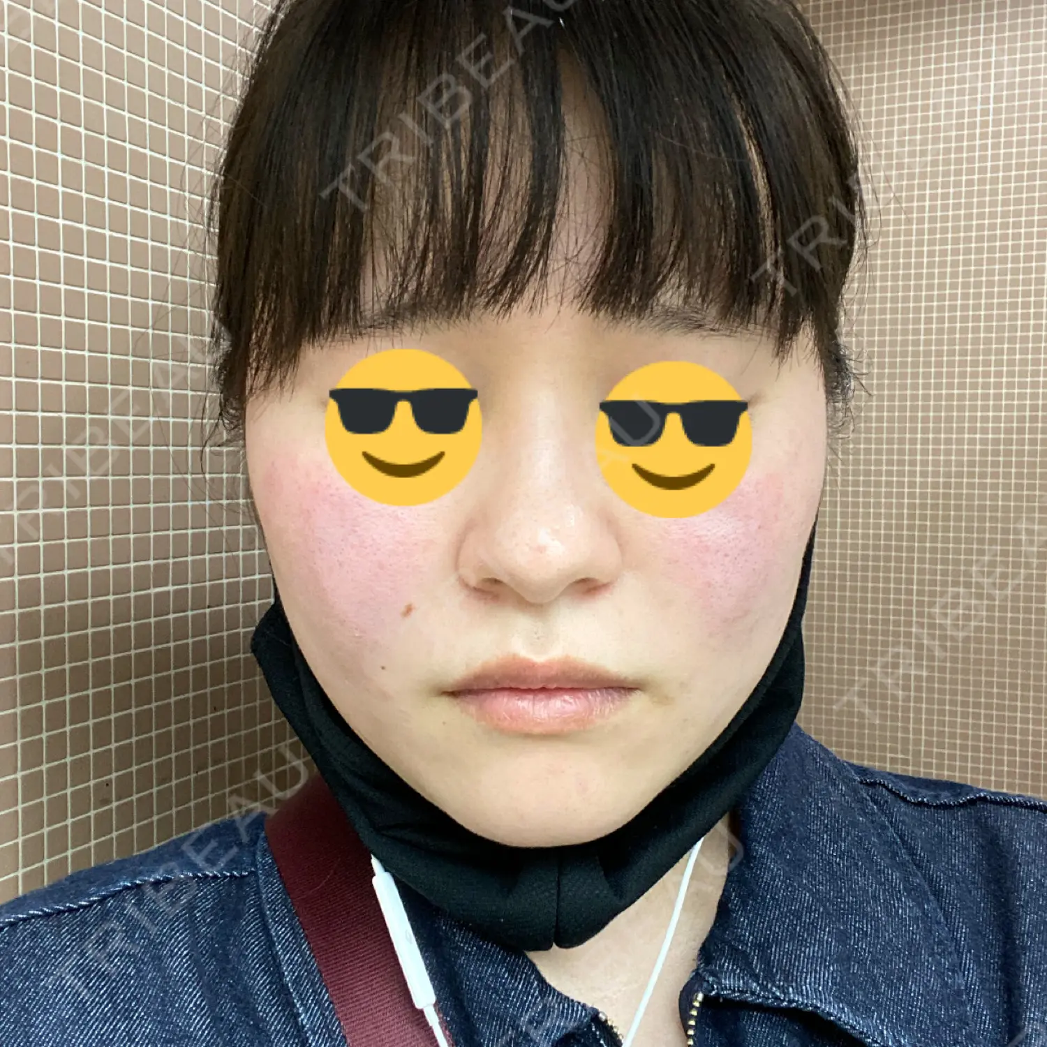 施術前の写真