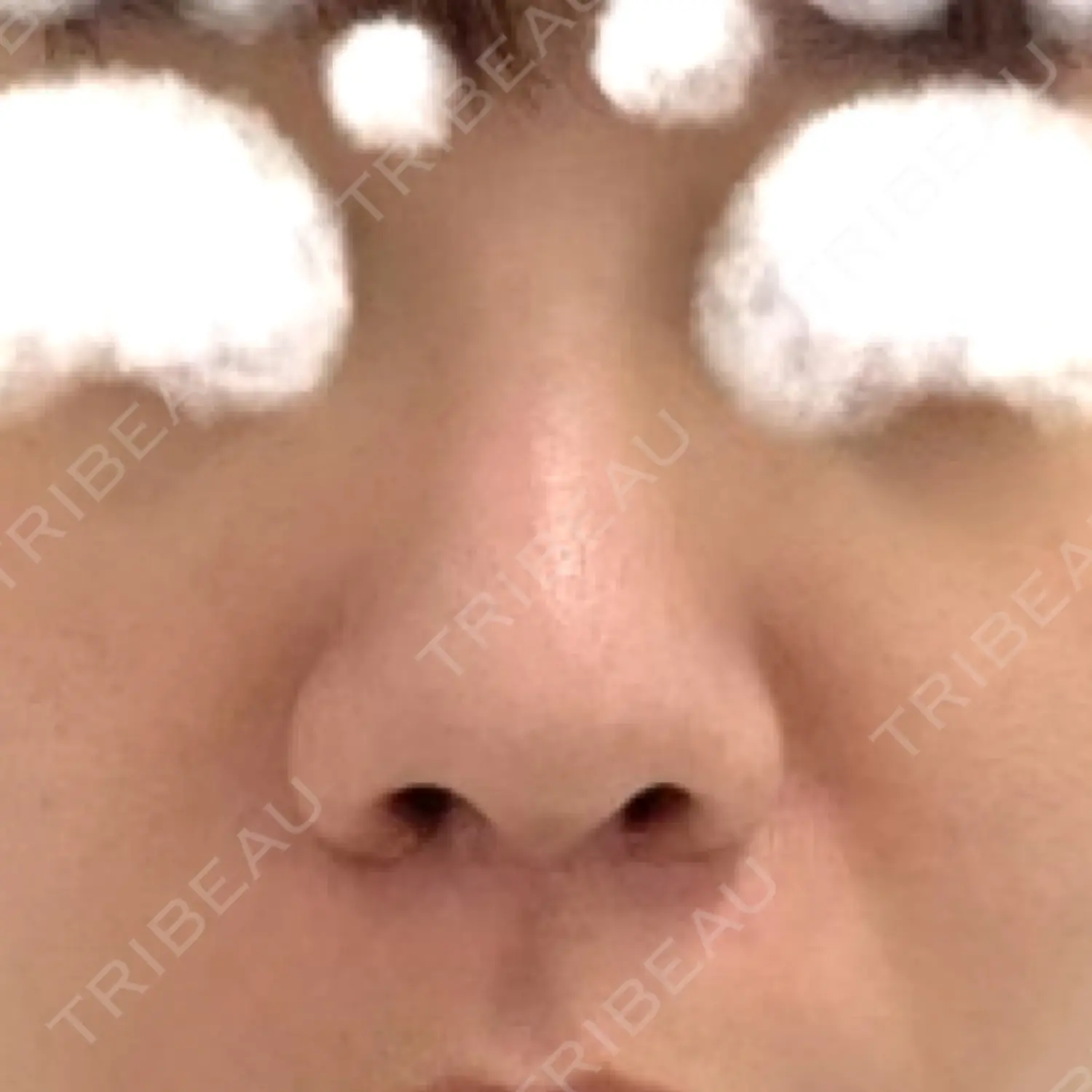 施術前の写真