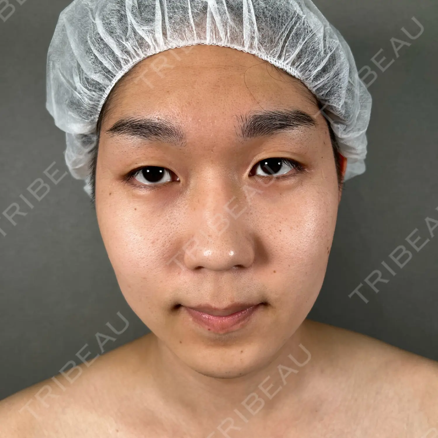 施術前の写真