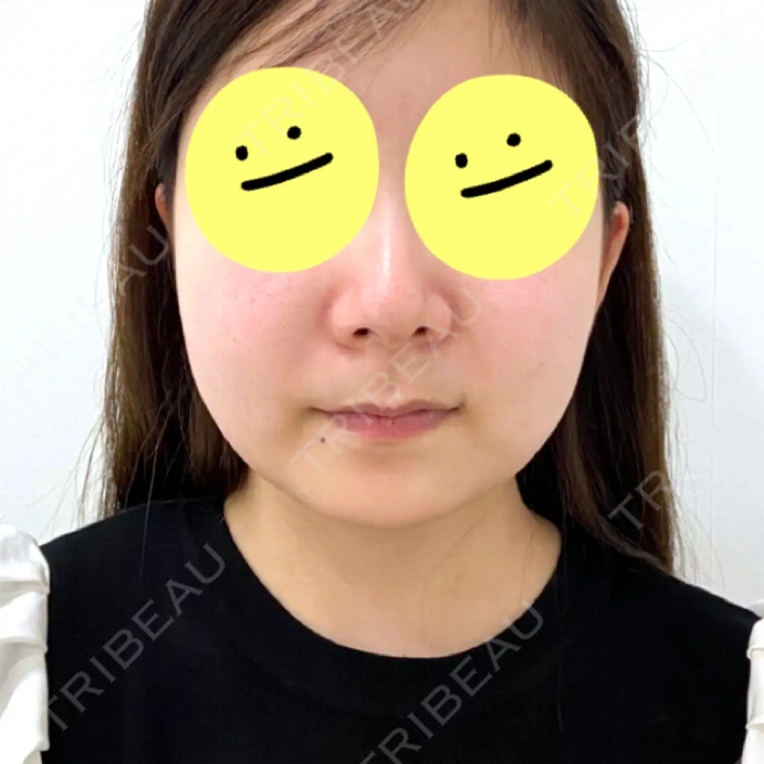 施術前の写真