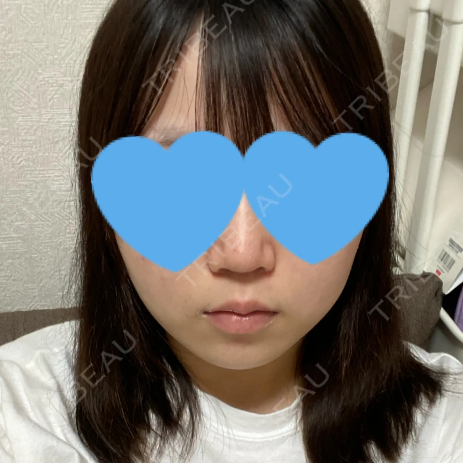 施術前の写真